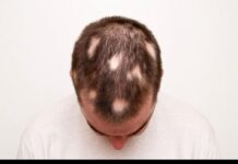 Coluna de saúde : “Alopecia Areata” compreender, identificar e tratar com base na ciência